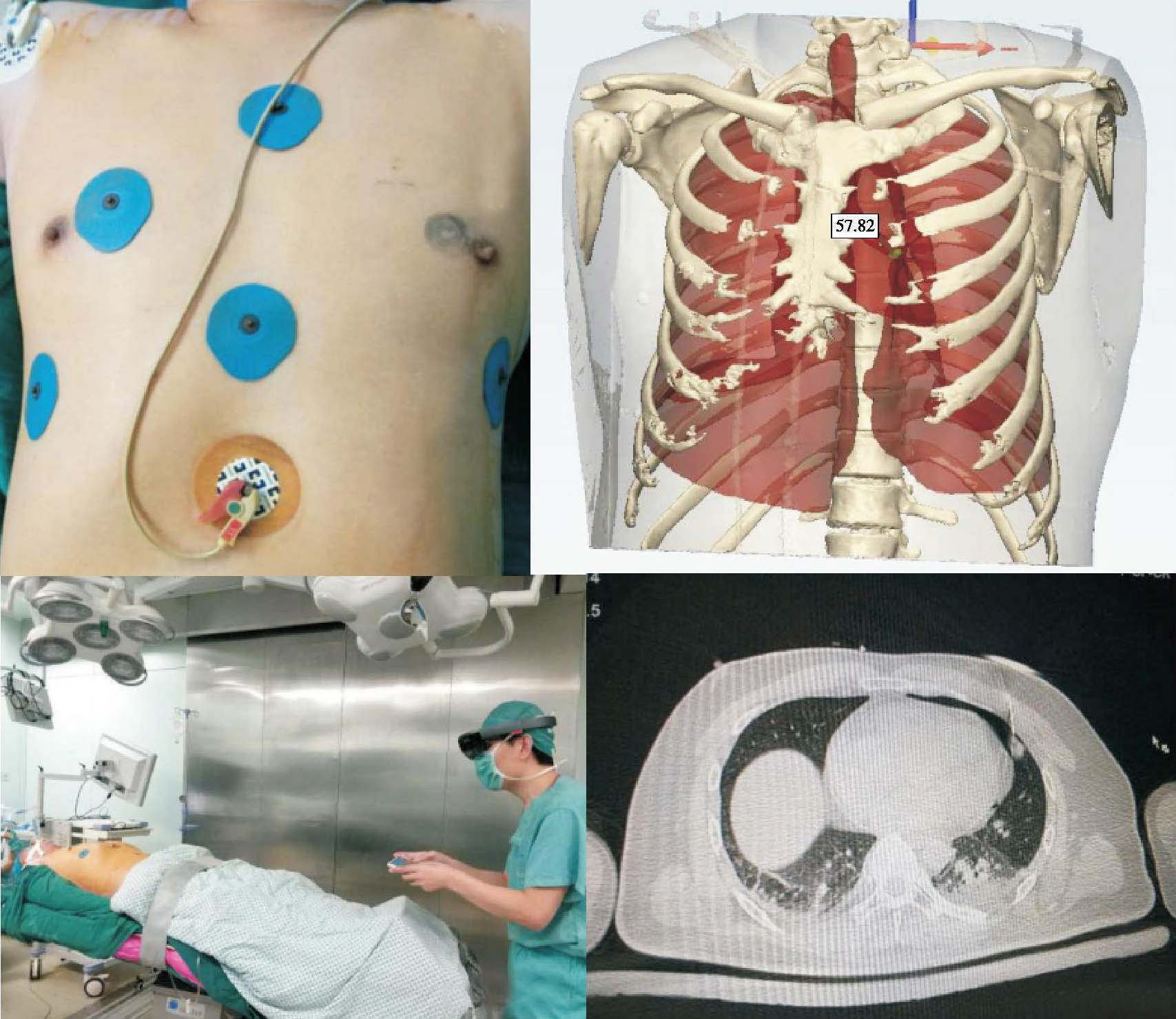 第二节 混合现实技术在胸外科手术中的应用实例